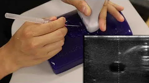 Ultrasound Guided Peripheral IV Placement