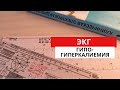 Гипокалиемия. Гиперкалиемия. ЭКГ диагностика и физиология.