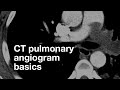 Pulmonary CT Angiogram Basics