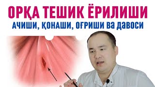 ОРҚА ТЕШИК ЁРИЛИШИ, АЧИШИ, ҚОНАШИ, ОҒРИШИ АНАЛ ТРЕЩИНА САБАБИ ВА УЙ ШАРОИТИДА ДАВОСИ ДАҚҚИДА ИСЧАНОВ