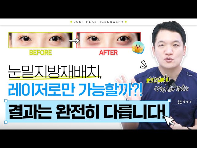눈밑지방재배치, 레이저로만 받으면 무조건 망합니다. #강남성형외과 #저스트성형외과