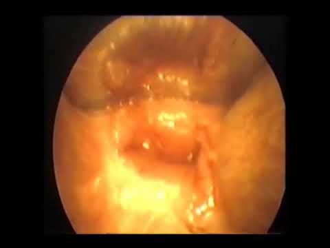 CONSERVATIVE SURGICAL REPAIR IN CERVICAL ATRESIA ASSOCIATED WITH PARTIAL OR COMPLETE ABSENCE OF...