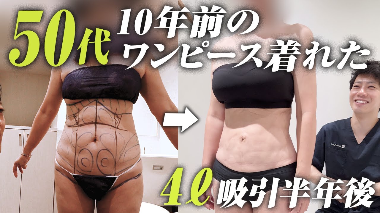 家族に「太った」と言われ決意したお腹の脂肪吸引から6ヶ月後の変化とは？ぽっこりお腹なくなる！？