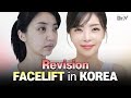 Revision facelift experience at vlif