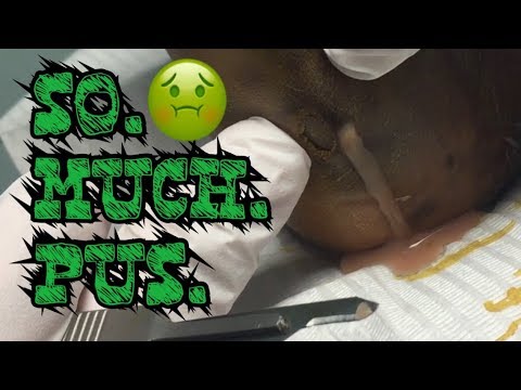 Video Foot Infection with Tons of Pus. Abscess with... - youtube