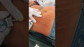 How to reduce stretch Marks and circles علاج  علامات  تمدد الجلد  shorts