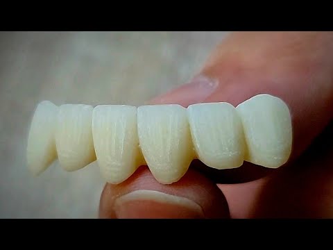    طريقة إنهاء الأسنان الأمامية لجسر زيركون