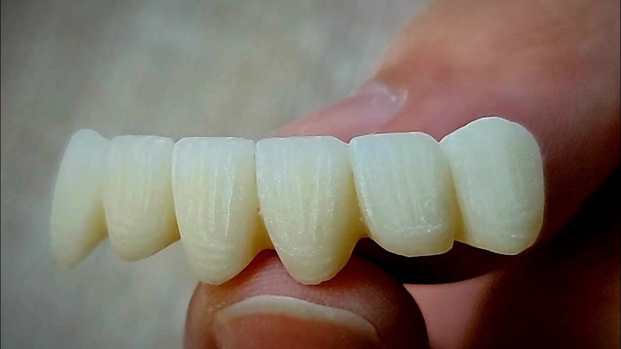 zircon Bridge finishing...طريقة إنهاء الأسنان الأمامية لجسر زيركون