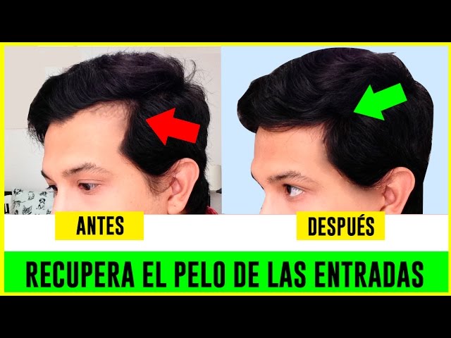 HOW TO GROW YOUR HAIR FAST | RECEDING HAIRLINE | HOMEMADE REMEDIES - YouTube