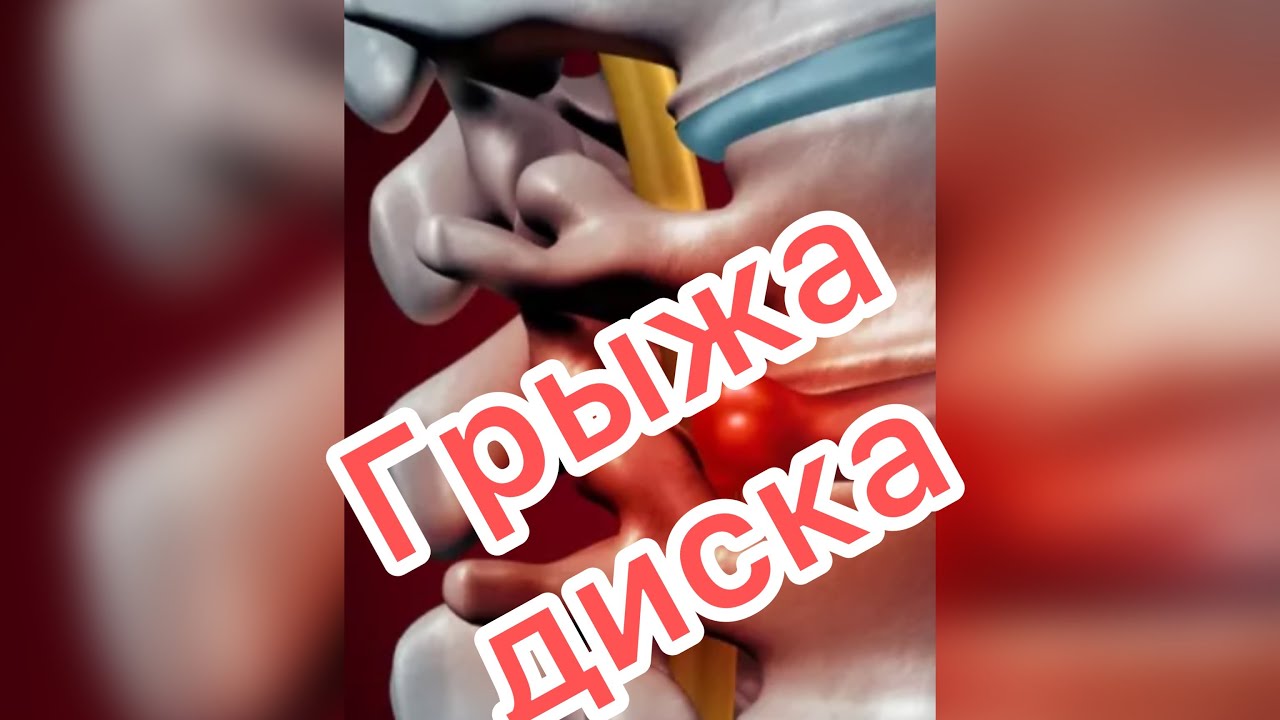 Межпозвоночная грыжа. Лечится или нет? - YouTube