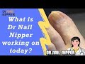 What is Dr Nail Nipper working on Today? How fast do big toenails grow?