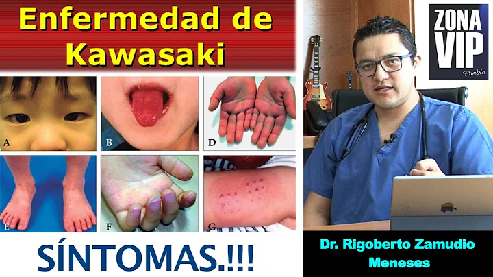 ENFERMEDAD DE KAWASAKI "Sntomas" Dr. Rigoberto Zam...