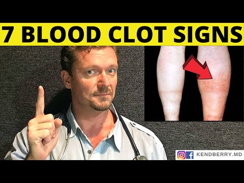7 Warning Signs of a BLOOD CLOT (Symptoms) 2022