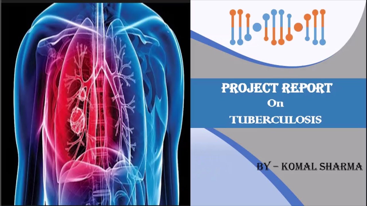 research project on tuberculosis