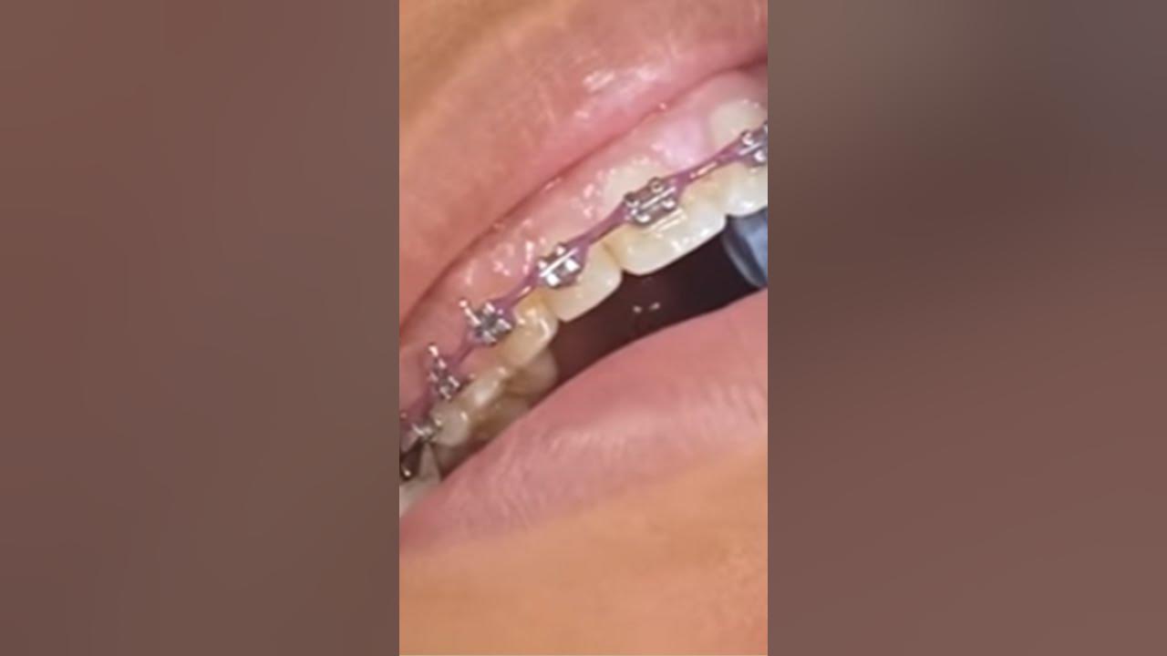 Braces Removal and Retainers on the SAME DAY YouTube