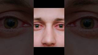 Ankhon Ki Allergy Ka Ilaj