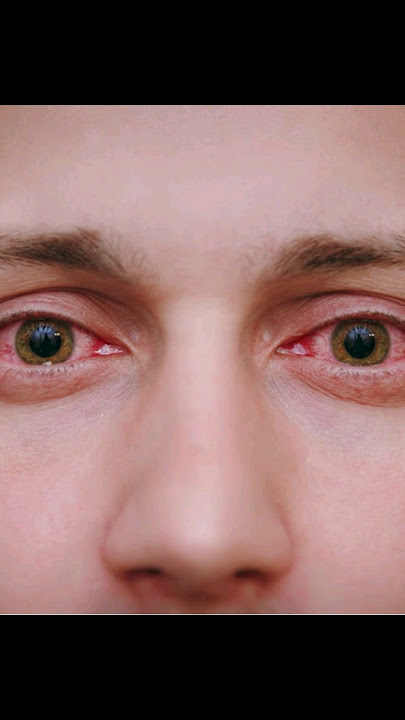 Treatment of Eye Allergy