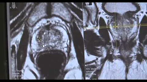 Quanto costa una biopsia prostatica Fusion a Roma?