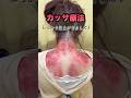 【カッサ療法】広島から来院した女性肩こりが広島では良くならなかった!そんな方を全力施術