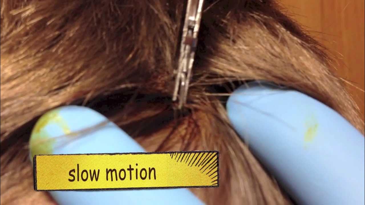 Expert advice on safely removing staples from wounds YouTube