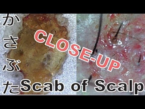 Dino Lite 頭の小さいかさぶたを剥がす The Very Small Scab Made On The Head Youtube