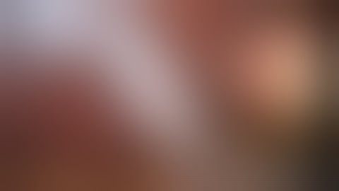 daVinci Robotic Multi Port Cholecystectomy 4 Trocar with FireFly (Fluorescent Cholagiography)