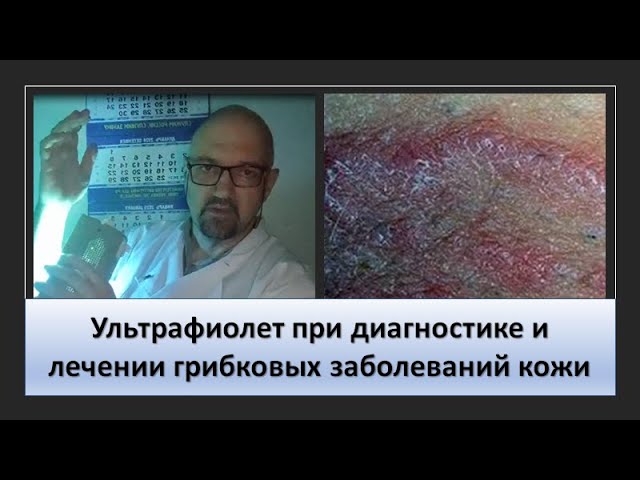 Ультрафиолет при диагностике и лечении грибковых заболеваний кожи