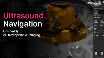 Brainlab Ultrasound Navigation – On-the-Fly Intraoperative 3D Imaging with BK Medical
