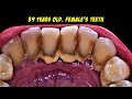 HOW TO REMOVE TARTAR BUILDUP | SCALING | Dentist | Dokter Gigi Tri Putra