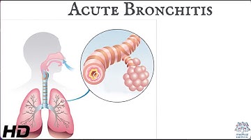 Acute bronchitis: Everything You Need To Know