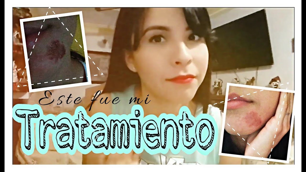 Remedios Para Ojos Irritados Por Soldadura