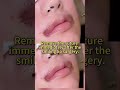 Smile lip stitch removal#整形#变美#Smiling Lips