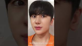 Korean Rhinoplasty Before And After Miho Plastic Surgery Korea