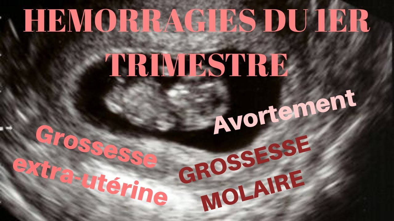 HEMORRAGIES DU 1ER TRIMESTRE DEMARCHE DIAGNOSTIQUE ET CONDUITE A TENIR — free download