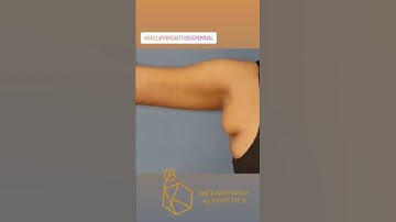 Single Keyhole Incision Armpit Tissue Removal #axillarybreastisuueremoval #shorts