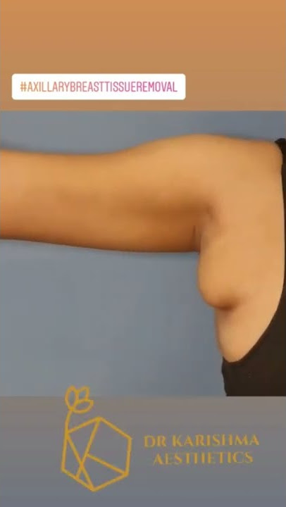 Single Keyhole Incision Armpit Tissue Removal #axillarybreastisuueremoval #shorts