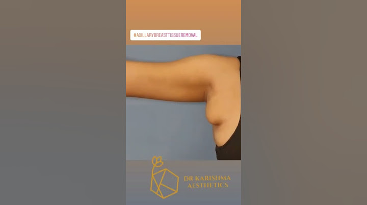 Single Keyhole Incision Armpit Tissue Removal #axillarybreastisuueremoval #shorts