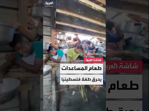 طفل فلسطيني يتعرض لحروق بعد انسكاب الطعام الساخن على جسده في قطاع غزة