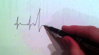 Cardiologist draws and explains the ECG of a ventricular ectopic beat