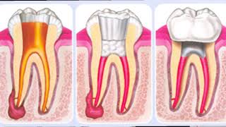 ماهي أسباب وجود ألم في الأسنان بعد علاج الجذور أو سحب العصب