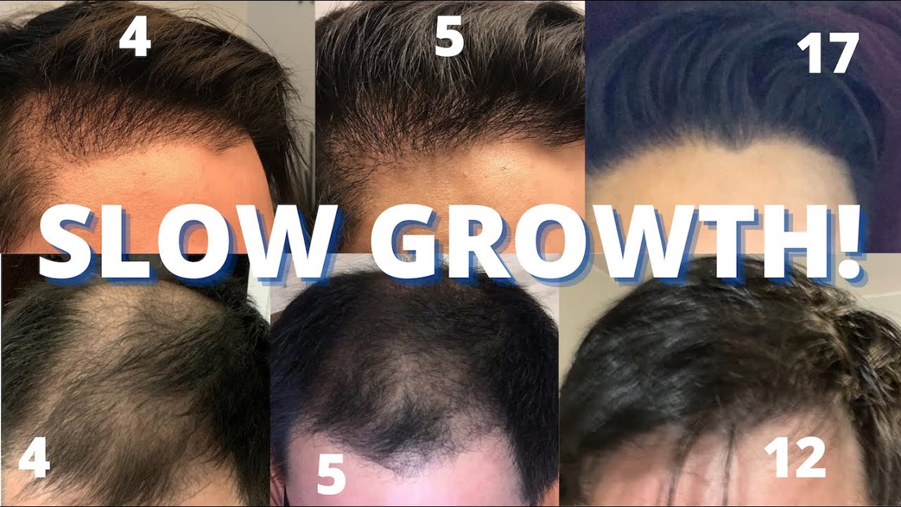 Reasons for Slow Hair Growth and Treatment Options