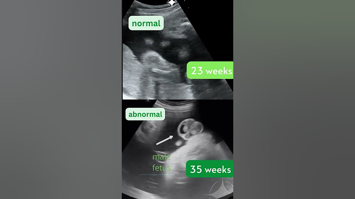 Ultrasound Showing Baby Boys 👶 Normal v Abnormal Testicles | Gender Reveal #shorts