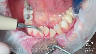 Pulizia Dentale Professionale dei denti Anteriori Inferiori (Professional Dental Cleaning)