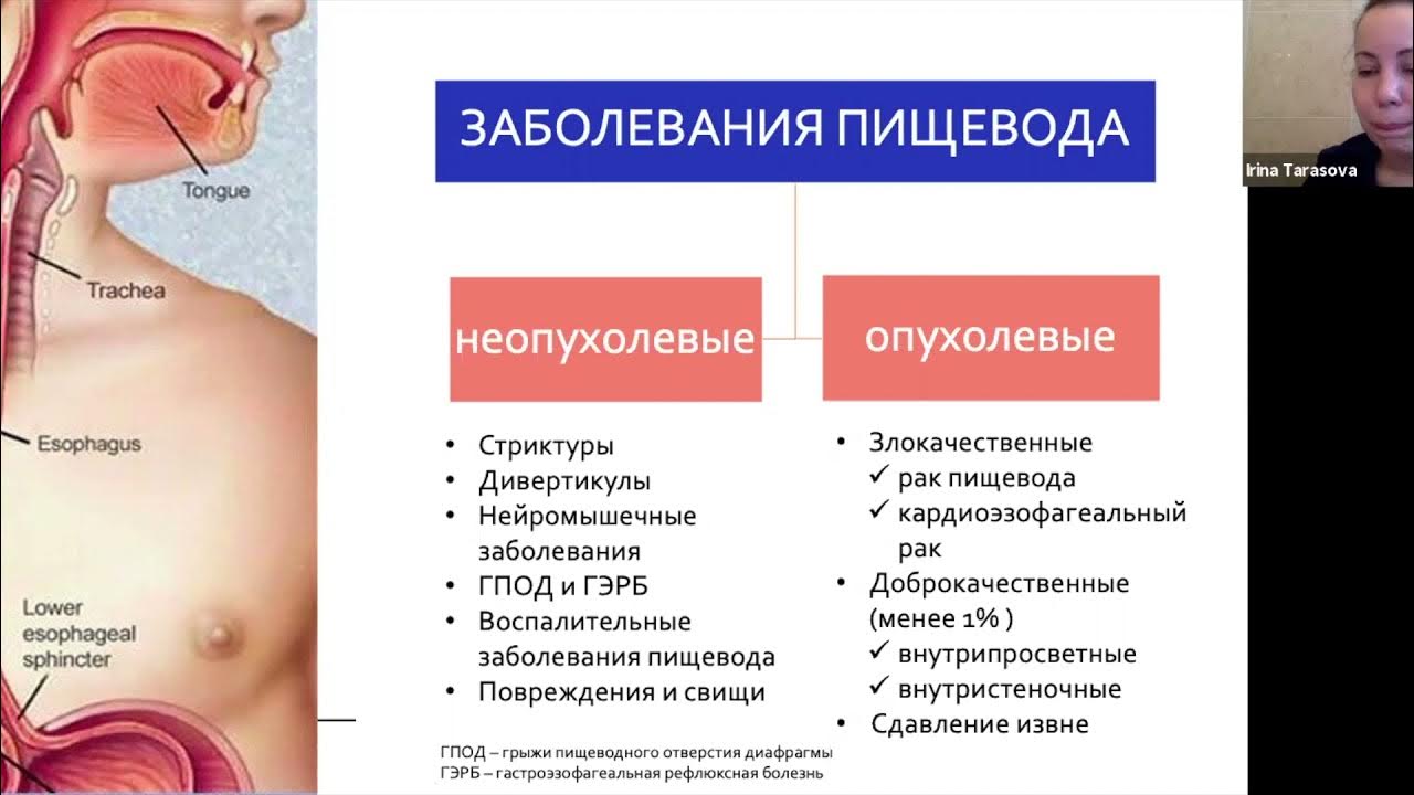 Болезни пищевода лечение. Глоточно-пищеводная дисфагия.