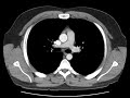 Anatomy of CT scans: Thoracic cavity