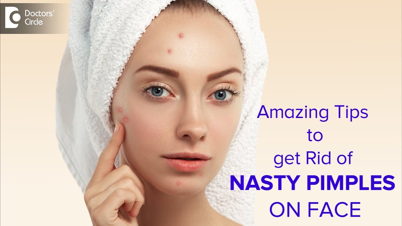 NASTY ACNE Why am I getting PIMPLES ON FACE? How to get rid of them