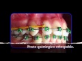 Tip #5. Corrección de la línea media dental - 1001 Tips en Ortodoncia