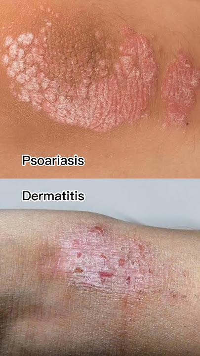 Penanganan Radang Kulit Dermatitis Eksim Psoariasis