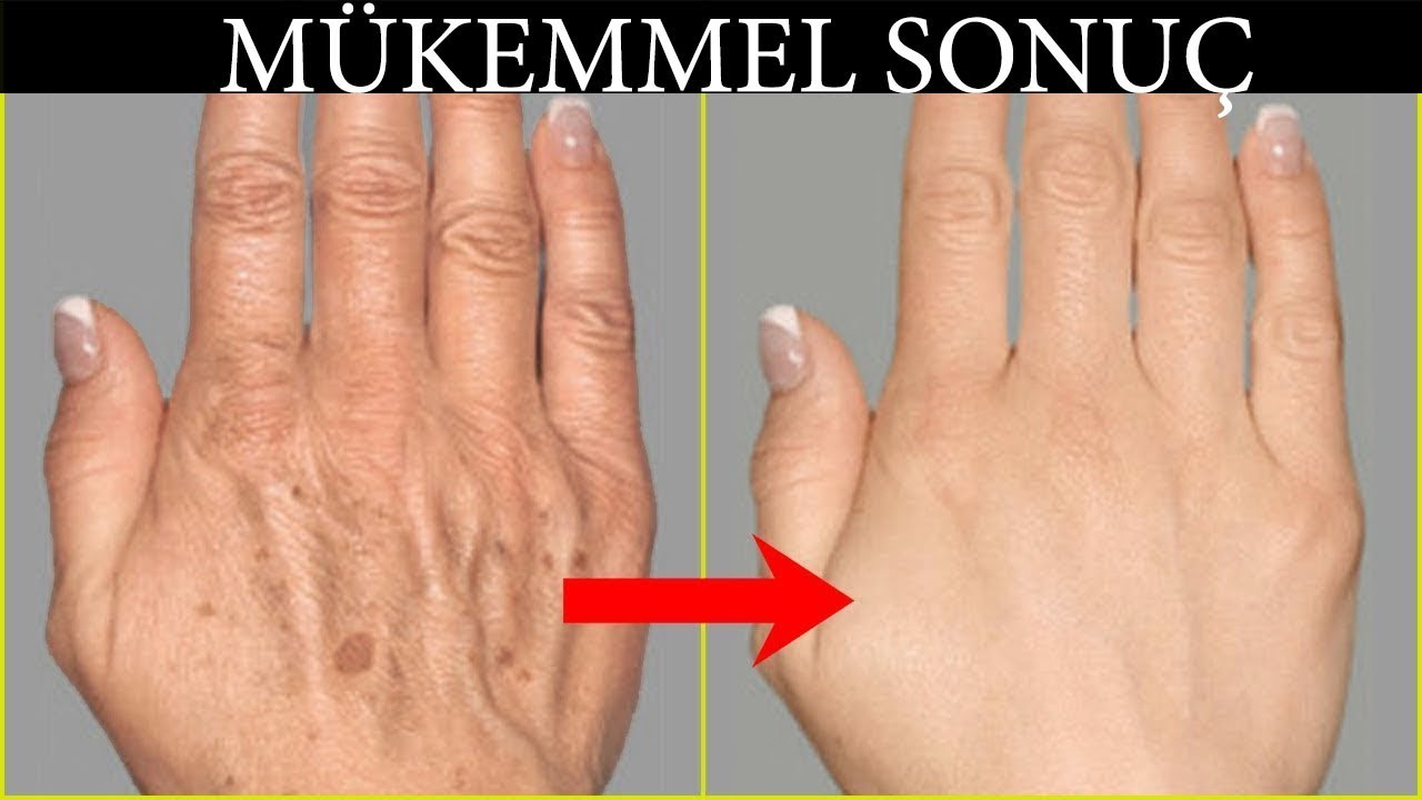 youtube home remedies for wrinkles wrinkles hands back acne treatment