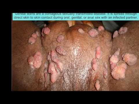 Internal Anal Warts - Pictures showing for Internal Anal Warts - www.mypornarchive.net